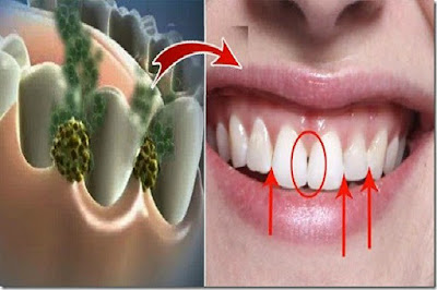 Eliminate Bad Breath In 5 Minutes! This Remedy Will Destroy All The Bacteria That Cause Bad Breath!