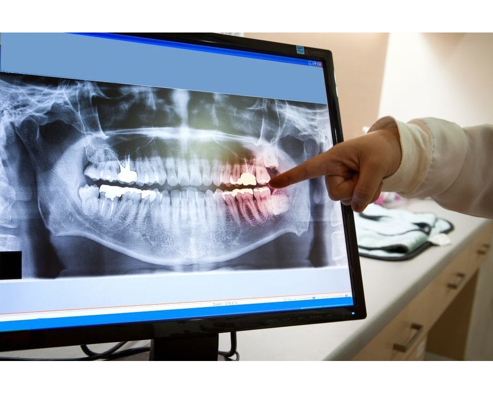 Why do Dentists take XRays? OdontoVida