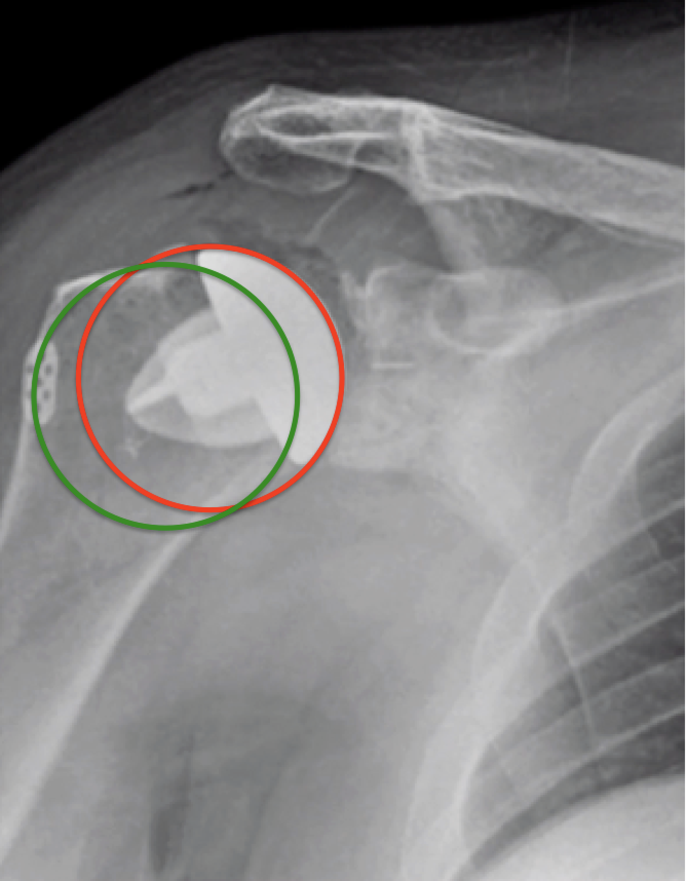 UW Shoulder and Elbow Academy Overstuffing and the importance of