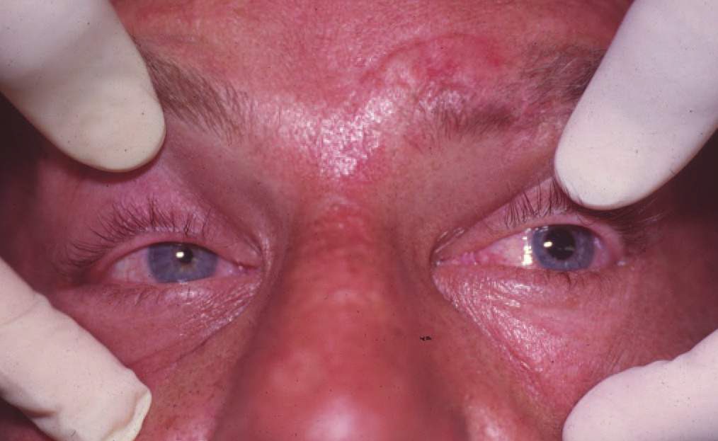 Study Medical Photos Uncal Herniation Syndrome After Severe Head Injuries