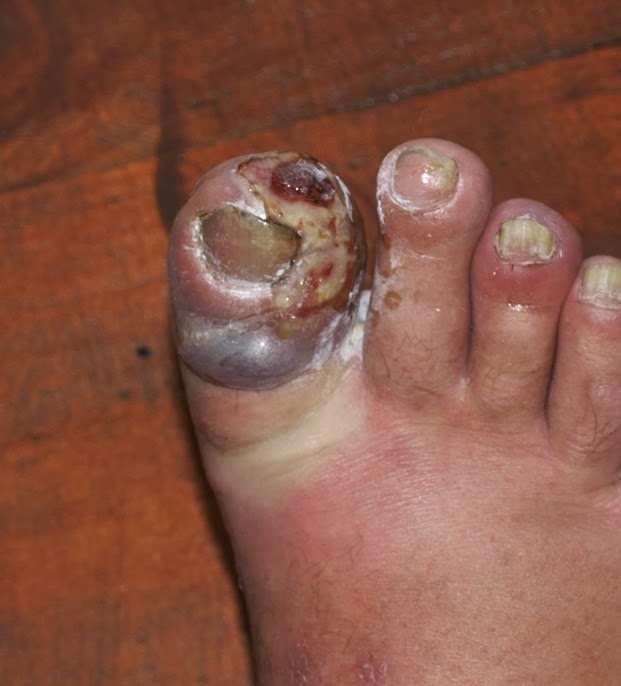 How to Treat a Foot Blister: 10 Steps (with Pictures ...