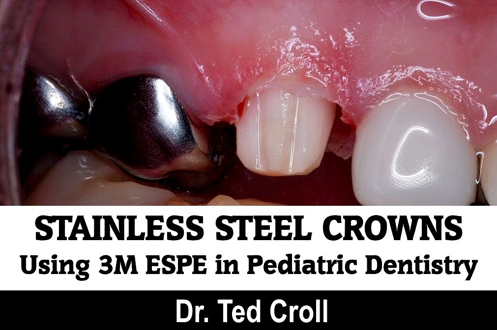 STAINLESS STEEL CROWNS Using 3M ESPE in Pediatric Dentistry Dr. Ted