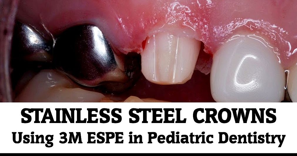 STAINLESS STEEL CROWNS Using 3M ESPE in Pediatric Dentistry Dr. Ted Croll OdontoTv