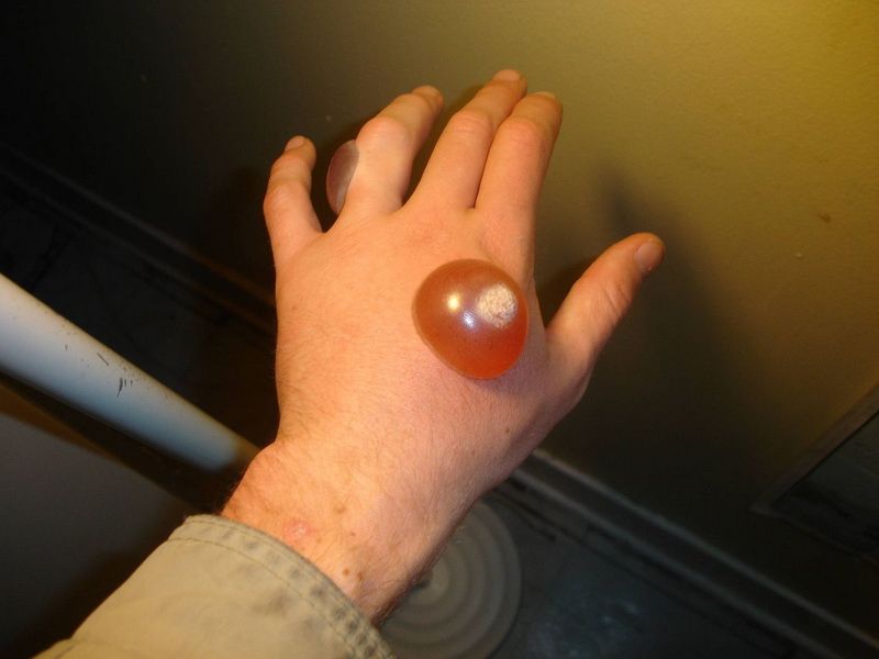 Liquid Nitrogen Burn