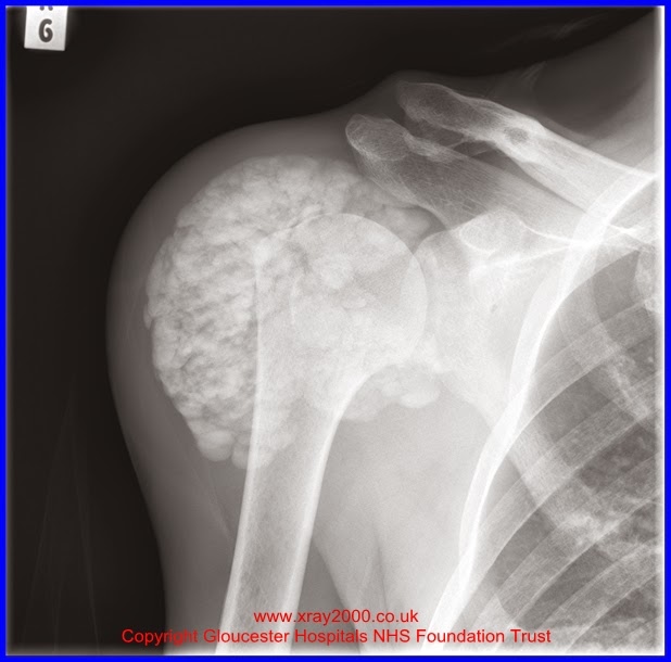 The Amazing Bodybuilding Bursitis Shoulder Exercises Take Charge Of