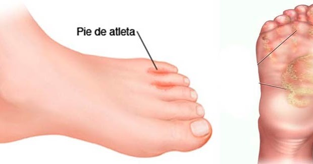 Como sanar el hongo de las uñas en los pies la diabetes