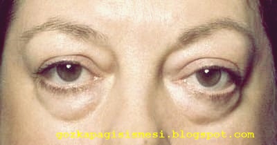 Gozlerin Sismesine Neden Olan Besinler Genel Saglik Haberleri