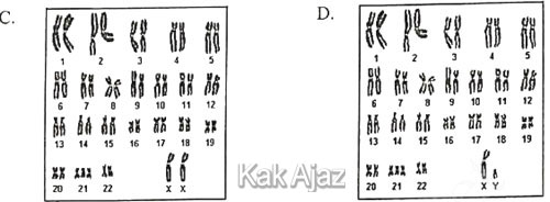 Opsi C dan D Soal Biologi UN 2019 tentang mutasi gen dan kromosom, down syndrome laki dan perempuan, kelaian pada kromoson no. 21, 45AA + XX/XY