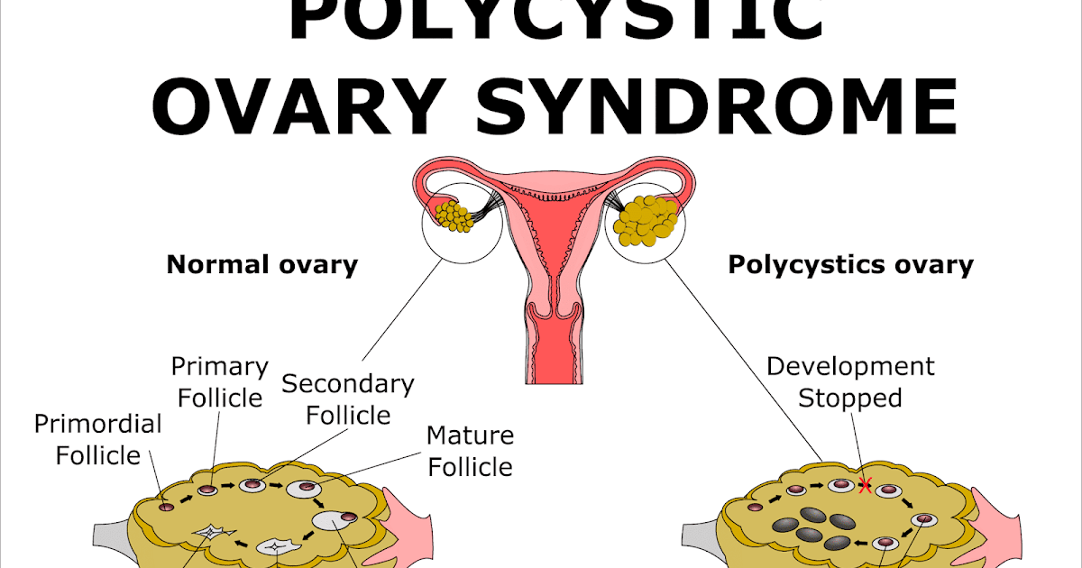 Polycystic Ovary Syndrome - Pictures