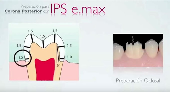 IPS E.MAX: Restauraciones anteriores y posteriores con alta estética - Videoconferencia del Dr. Sergio Hernández