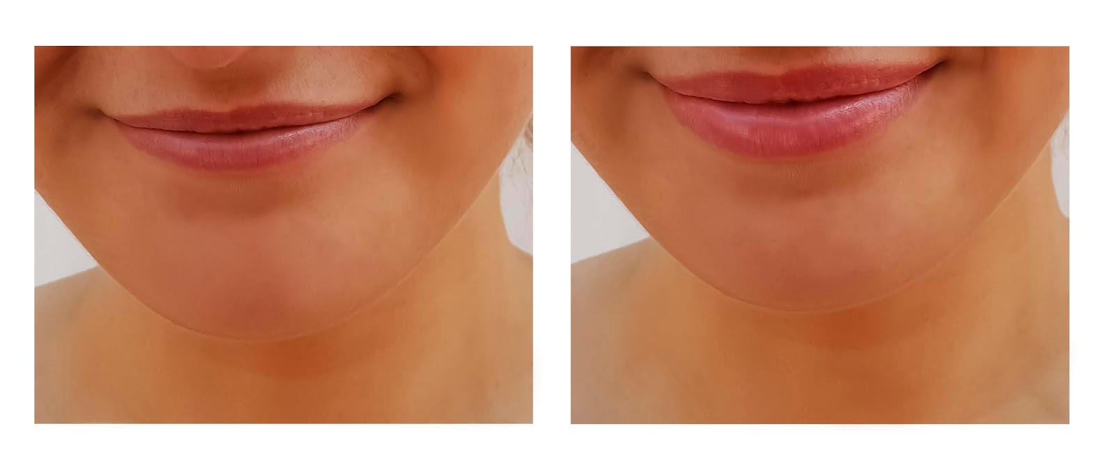 Aesthetics by Silvie Lip Dermal Filler & Smile Enhancements