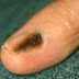 Μελάνωμα στο νύχι, στις άκρες των δακτύλων. Σκούρες γραμμές στα νύχια μπορεί να οφείλονται σε αιμάτωμα ή καρκίνο; 
