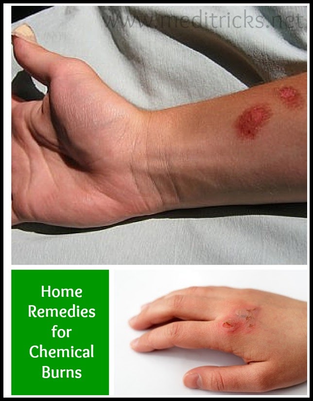 Home Remedies for Chemical Burns Medi Tricks