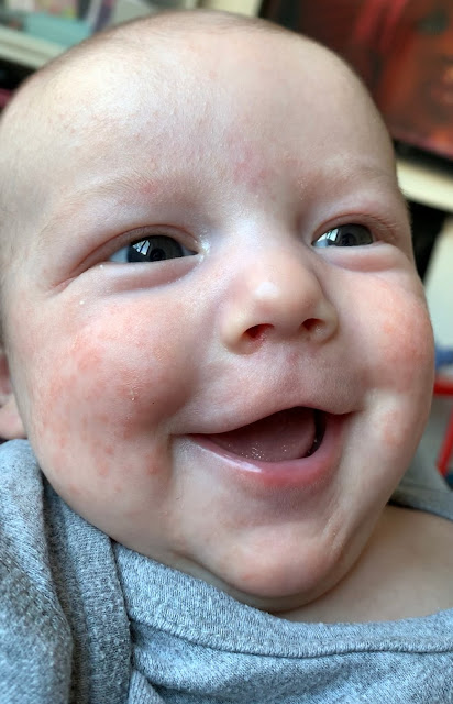 Smiling newborn baby boy with baby acne or eczema