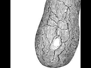 Gallbladder stone