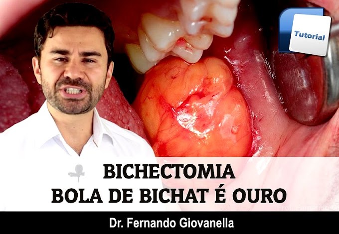 BICHECTOMIA: Bola de Bichat é OURO - Dr. Fernando Giovanella