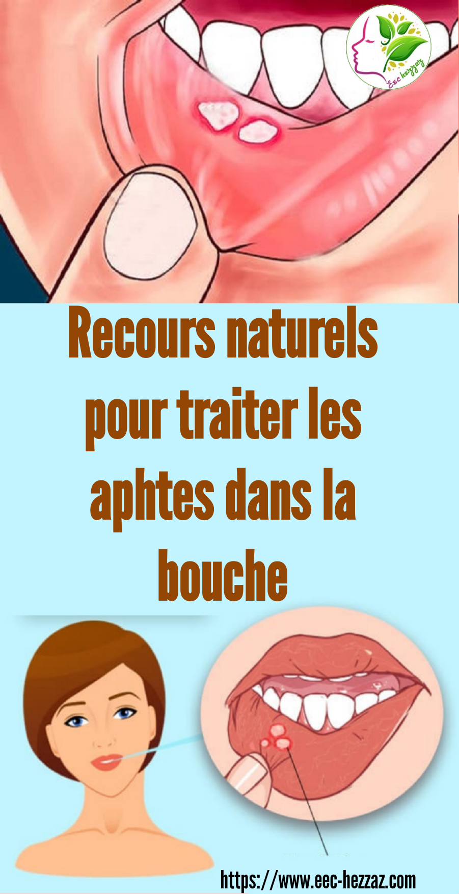 Recours naturels pour traiter les aphtes dans la bouche