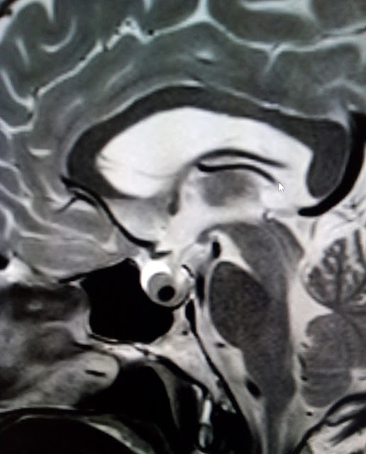 Rathke's Cleft Cyst: MRI - Sumer's Radiology Blog