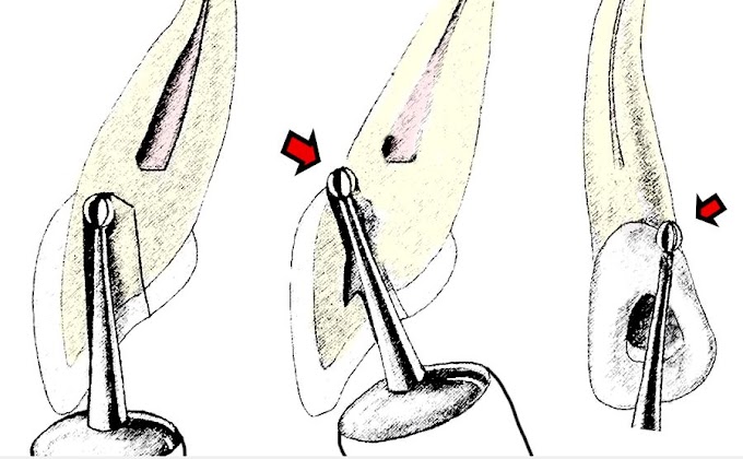 ENDODONTIC: Dystrophic Calcification and Instrument removal
