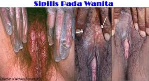Sipilis Pada Wanita Sipilis Pada Wanita