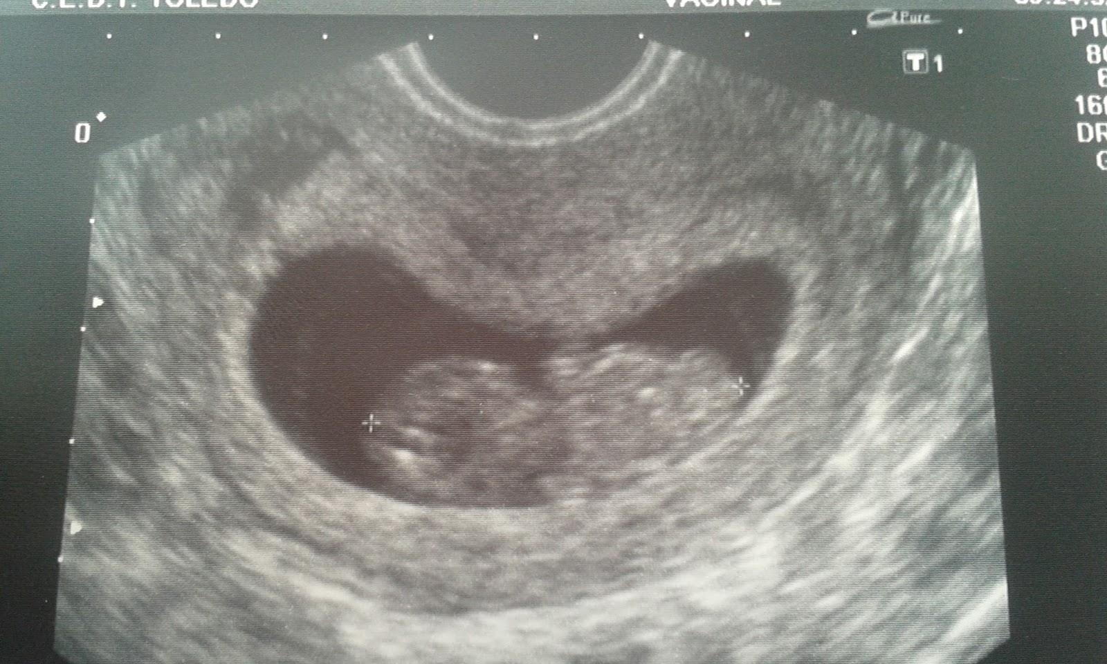 SuperMamiNovati: ECOGRAFIA 8 SEMANAS Y 10 SEMANAS