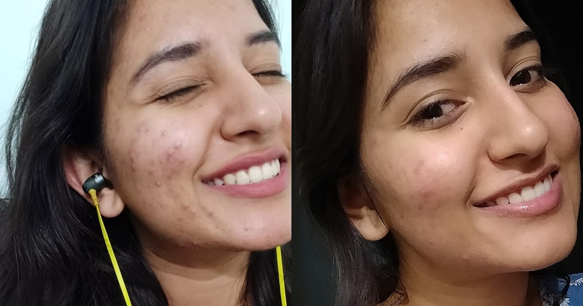 CAUSES OF ACNE THAT NO ONE TALKS ABOUT!! FOR WOMEN AND MEN.