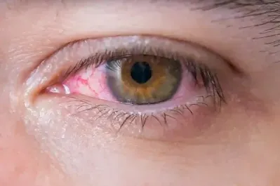علاج الم العين بالعلاجات المنزلية