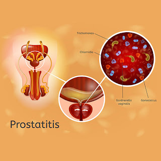 Prostatitis