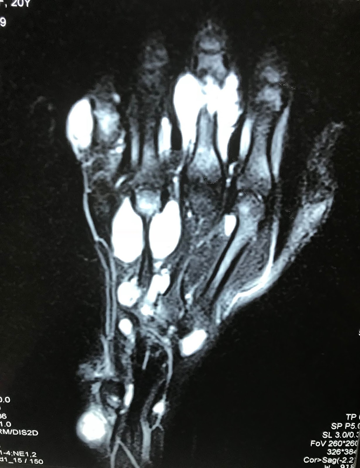 VIETNAMESE MEDIC ULTRASOUND CASE 518 FINGER TUMORS, Dr PHAN THANH HẢI