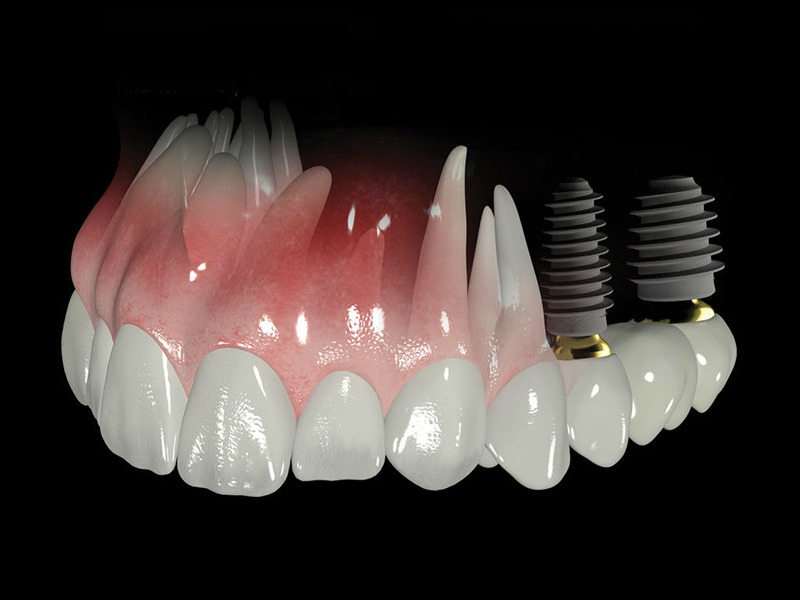 ¿Por qué se utiliza el zirconio? ¿Por qué se utiliza el zirconio?