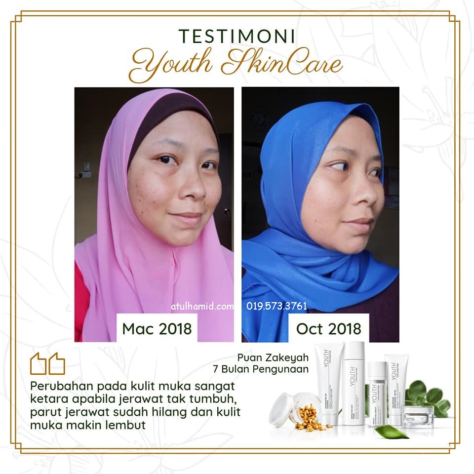 Testimoni Youth Skincare: Masalah Kulit Jerawat Tiada Lagi