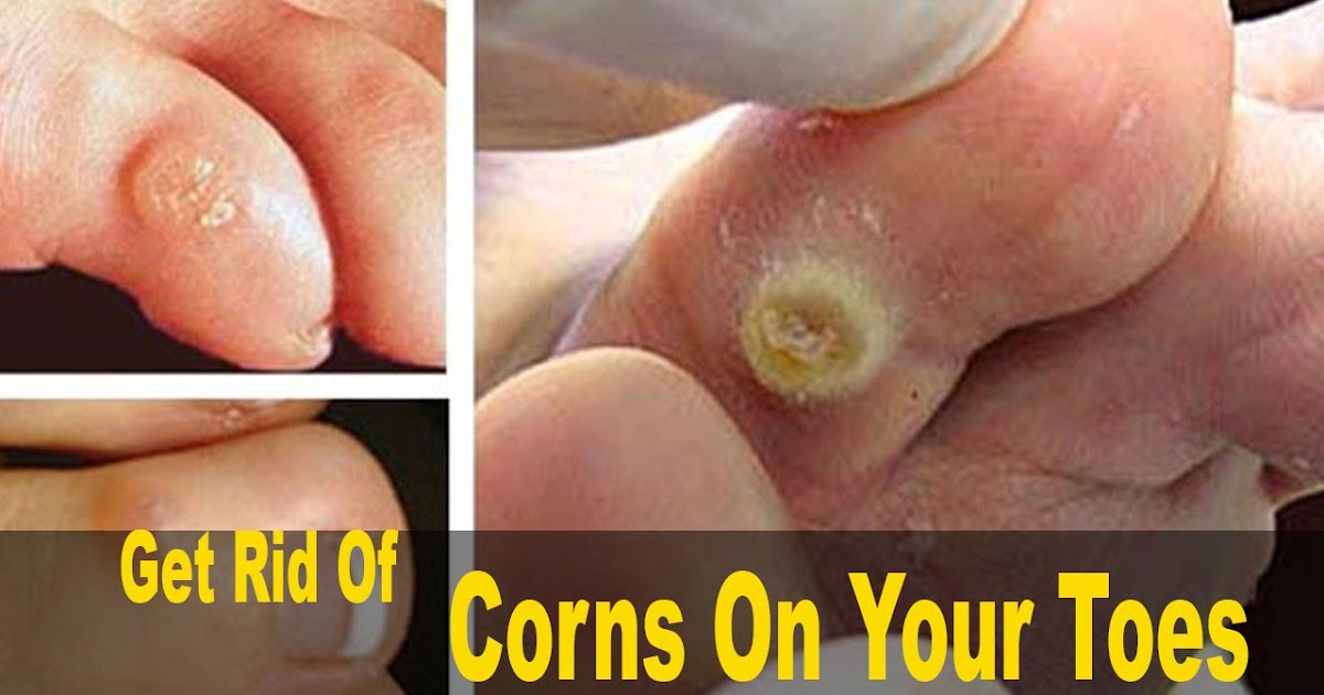 4 Easy Tips To Get Rid Of Corns Quickly!