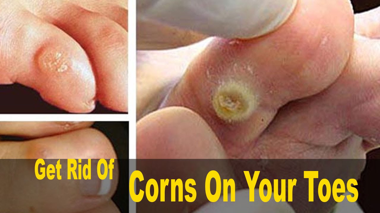 4 Easy Tips To Get Rid Of Corns Quickly!