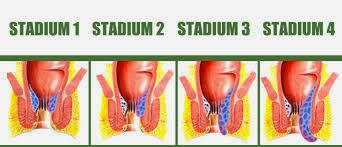 Stadium Ambeien Atau Wasir Stadium Ambeien Atau Wasir