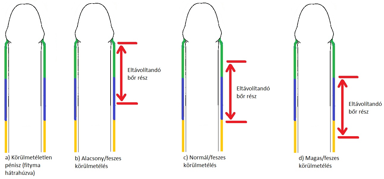 pénisz sűrítők és hosszabbítók