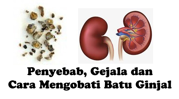 gambar batu ginjal