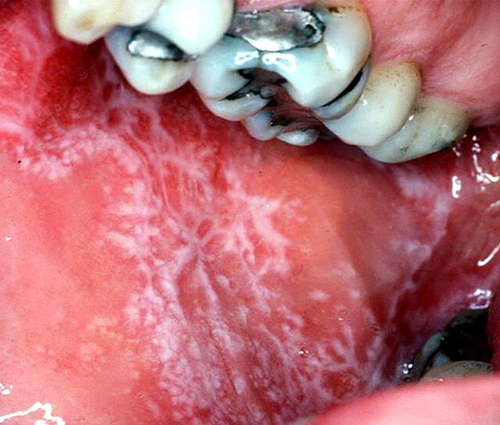 ORAL MEDICINE Smokeless Tobacco Lesions Directorio Odontológico