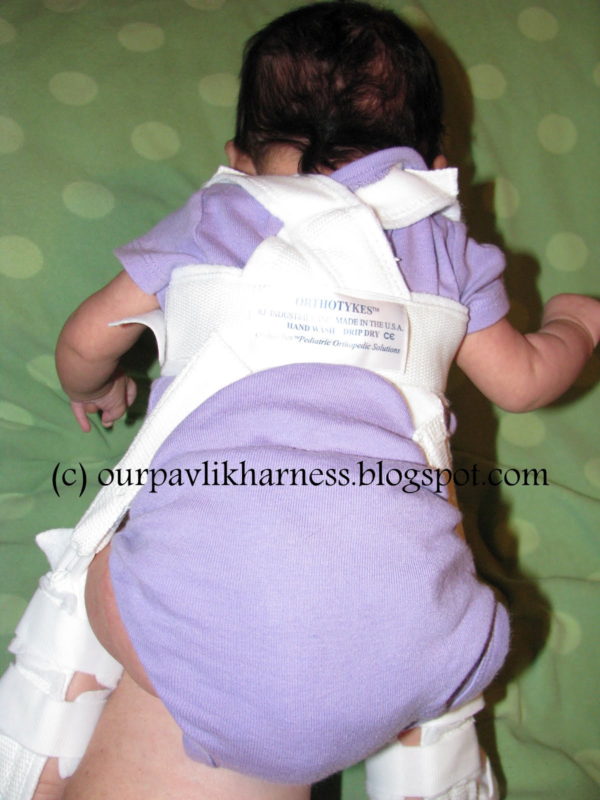 Our Pavlik Harness and journey with Hip Dysplasia Meet Pavlik