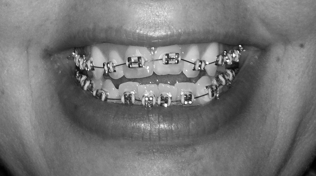 Braceface The Sequel (a jaw surgery and braces blog) Have you heard?