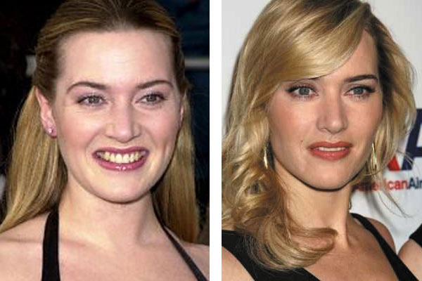 Kate Winslet Before and After Plastic Surgery Bad celebrity plastic surgery, Cel