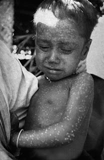 Bangladeşli iki yaşındaki Rahima Banu (resimde), 1975'te doğal olarak ortaya çıkan Variola majörüyle enfekte olan son kişiydi.