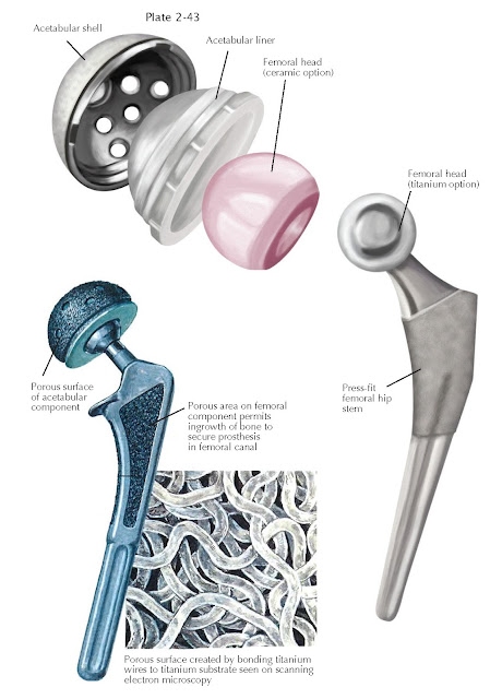 TOTAL HIP REPLACEMENT: PROSTHESES