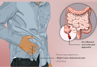 Appendicitis Causes Home Remedies and Treatment