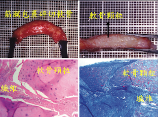 隆鼻,自體骨隆鼻,全自體隆鼻