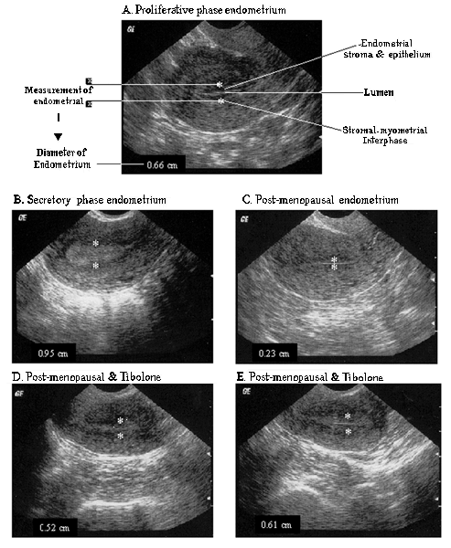 Поздняя стадия эндометрия. Лейомиосаркома матки УЗИ. Эндометрий по фазам цикла на УЗИ. УЗИ периовуляторная фаза.