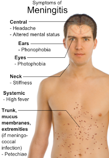 Apa itu meningitis, gejala dan faktor penyebabnya