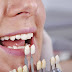 Những đối tượng cần lưu ý khi bọc răng sứ