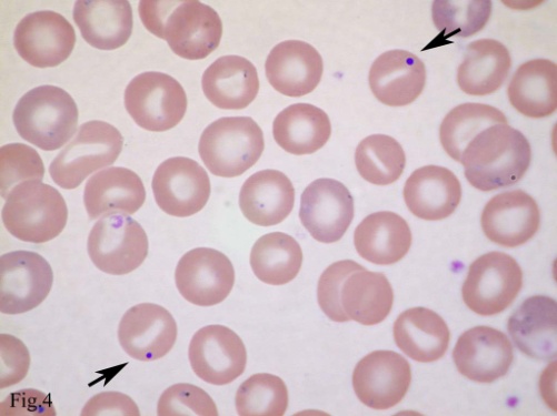 Photo of Hereditary stomatocytosis, stomatositosis herediter pada anemia hemolitik