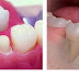 Lo lắng trồng răng hàm có đau không