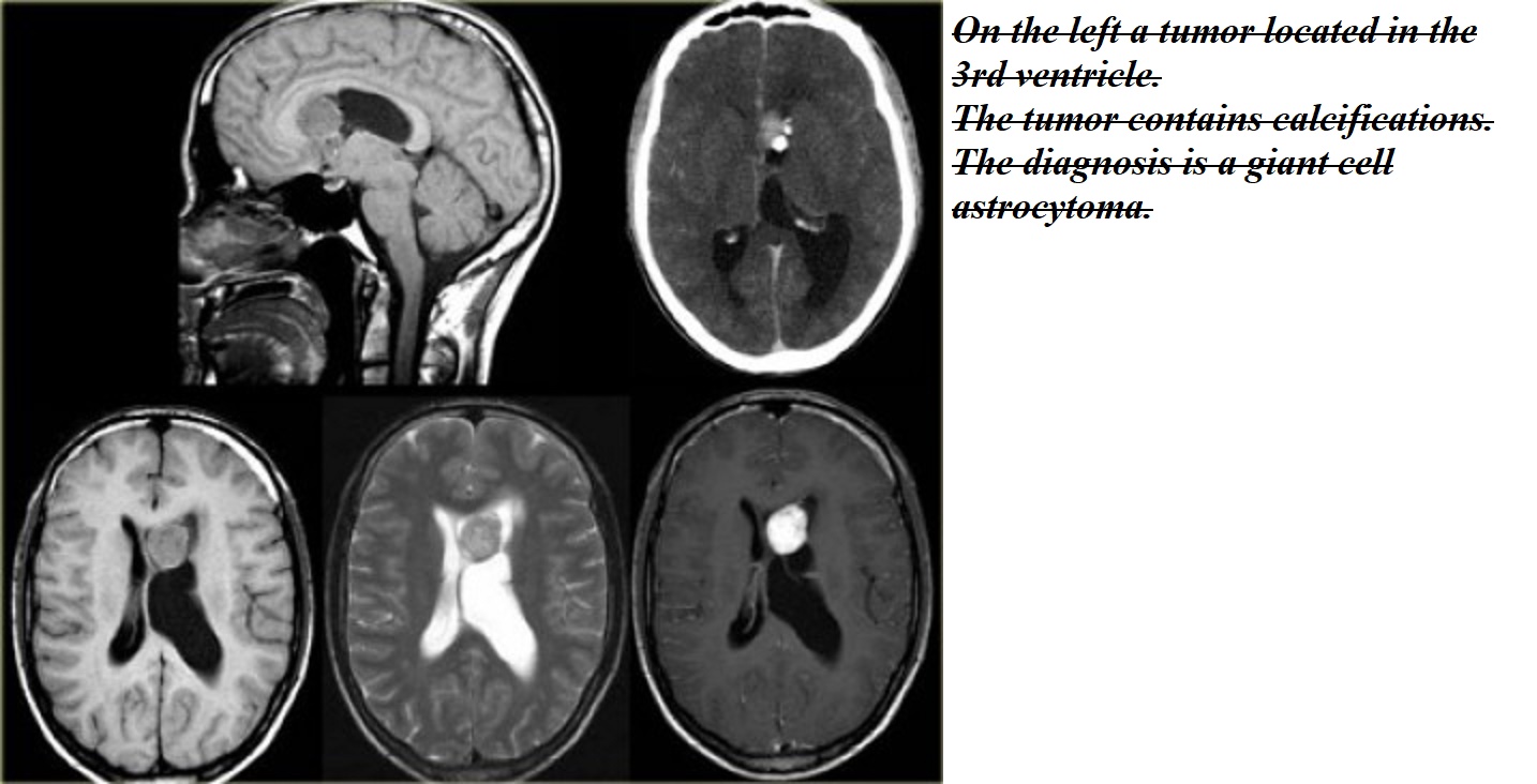 образование желудочков головного мозга. эпендимома iv желудочка. киста головного мозга на кт. образование желудочков головного мозга. киста желудочка головного мозга кт.